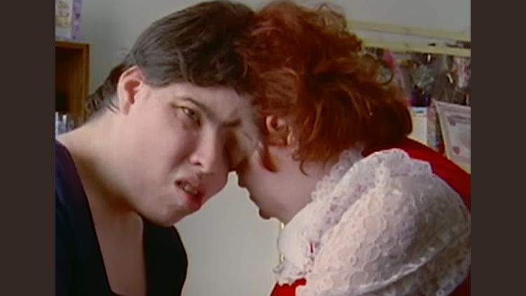 World’s Oldest Conjoined Twins Have Passed Away